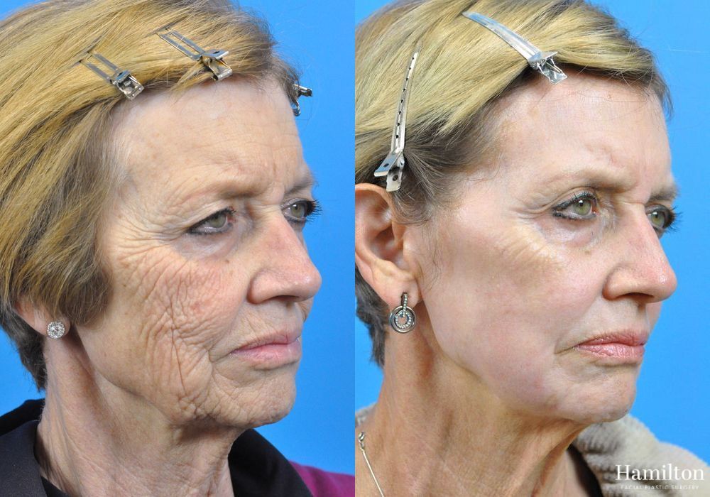 Before and after Laser - CO2 case 37170