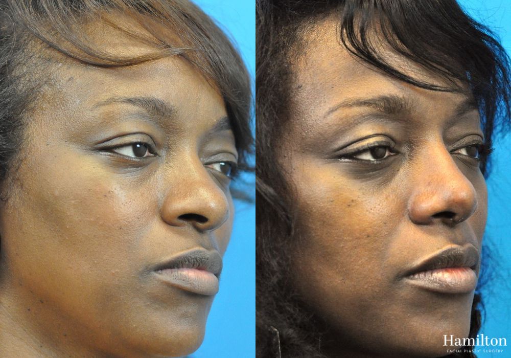 Before and after Rhinoplasty case 37295 - Angle 4