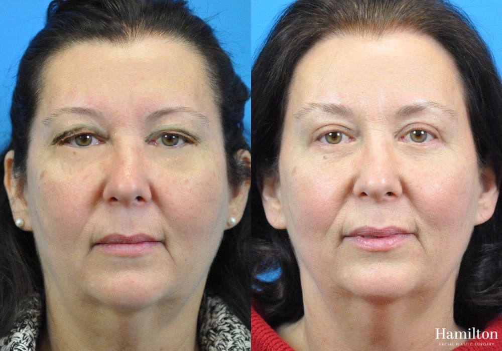 Before and after Brow Lift case 37229