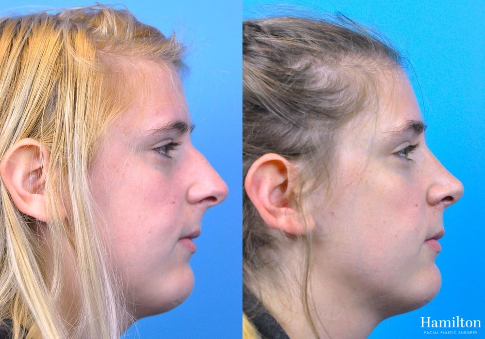Before and after Rhinoplasty case 37354
