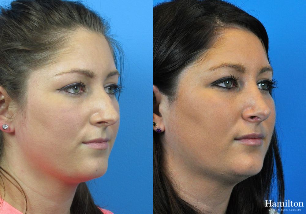 Before and after Rhinoplasty case 37356 - Angle 3