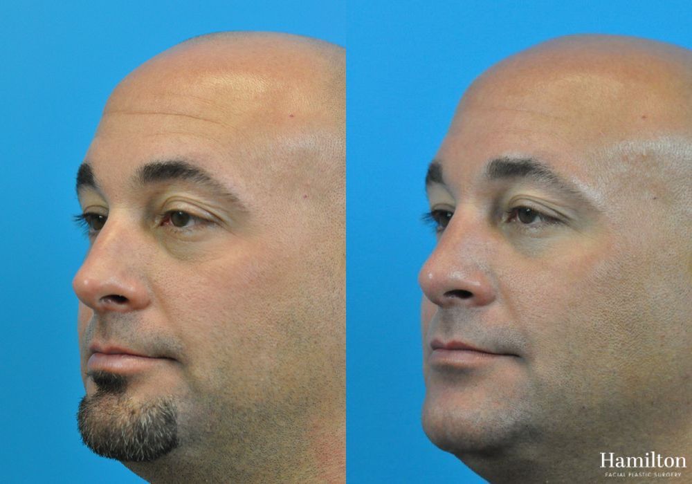 Before and after Rhinoplasty case 37255 - Angle 4