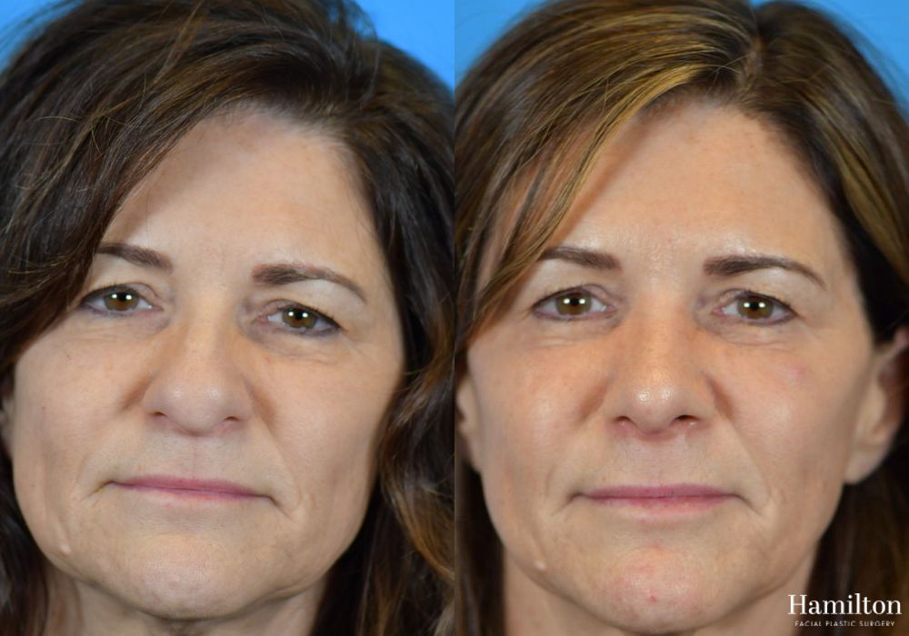 Before and after Rhinoplasty case 37299