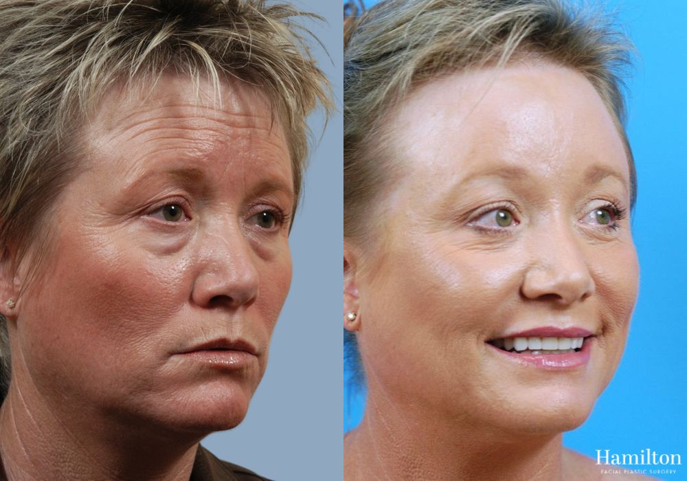 Before and after Laser - CO2 case 37224 - Angle 3