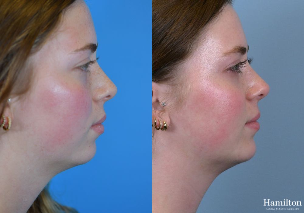 Before and after Chin Augmentation case 37176 - Angle 3