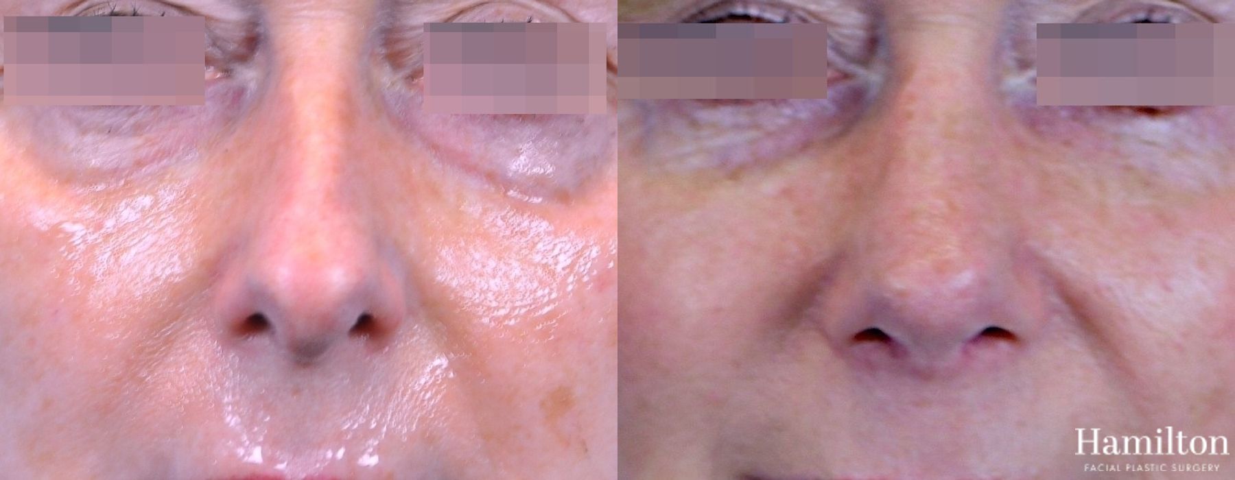 Before and after Rhinoplasty case 37352 - Angle 4