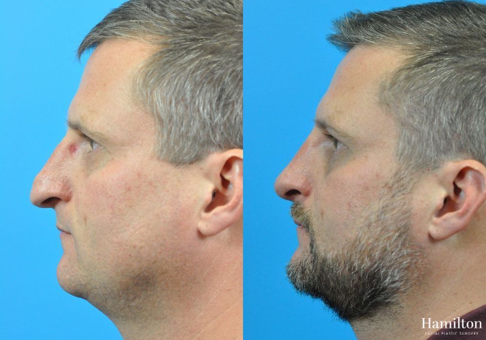 Before and after Rhinoplasty case 37312 - Angle 2