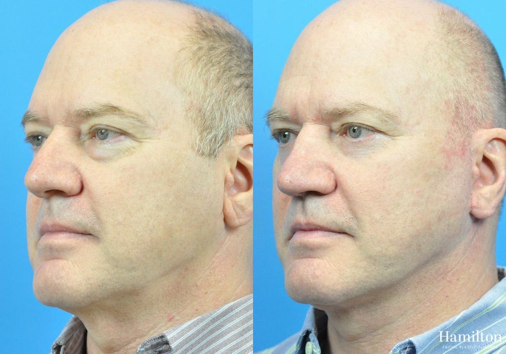 Before and after Rhinoplasty case 37264 - Angle 4