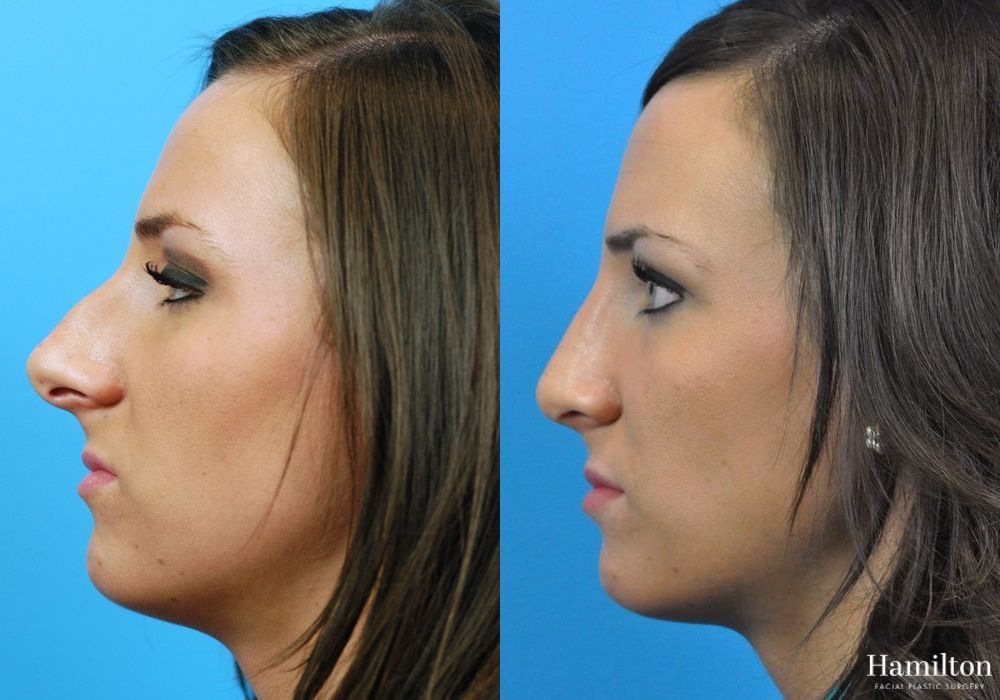 Before and after Rhinoplasty case 37287 - Angle 2