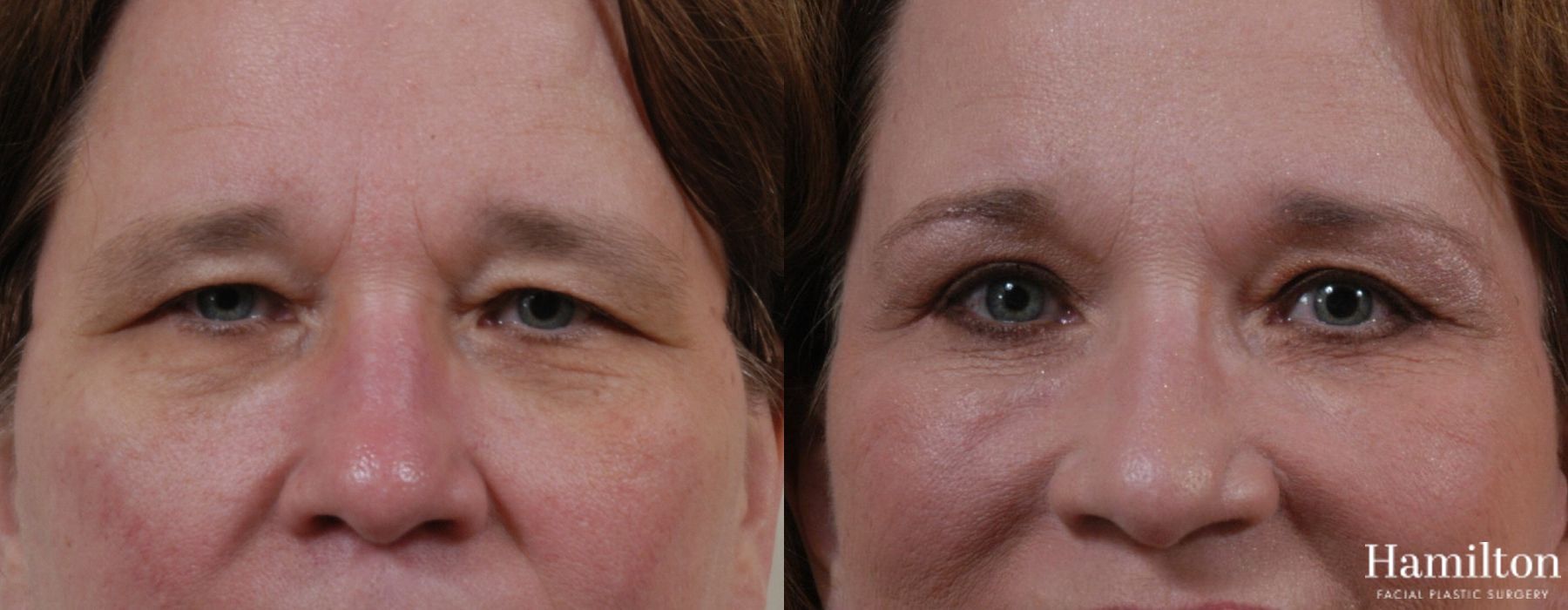 Before and after Blepharoplasty case 37270