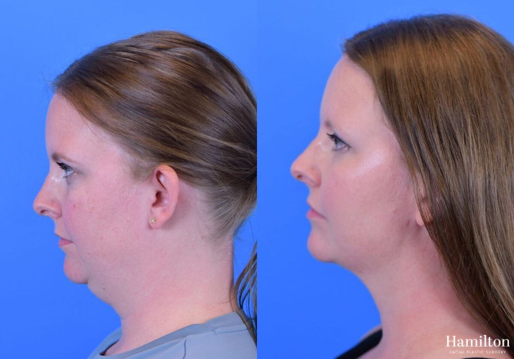 Before and after FaceTite case 37108 - Angle 3