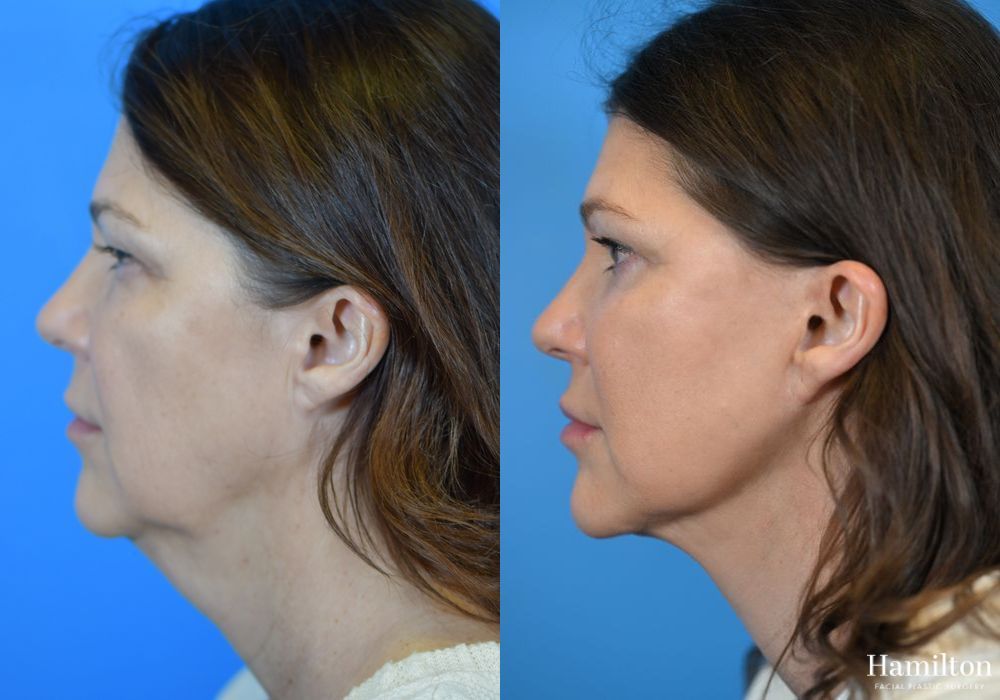 Before and after Neck Rejuvenation case 37215 - Angle 4