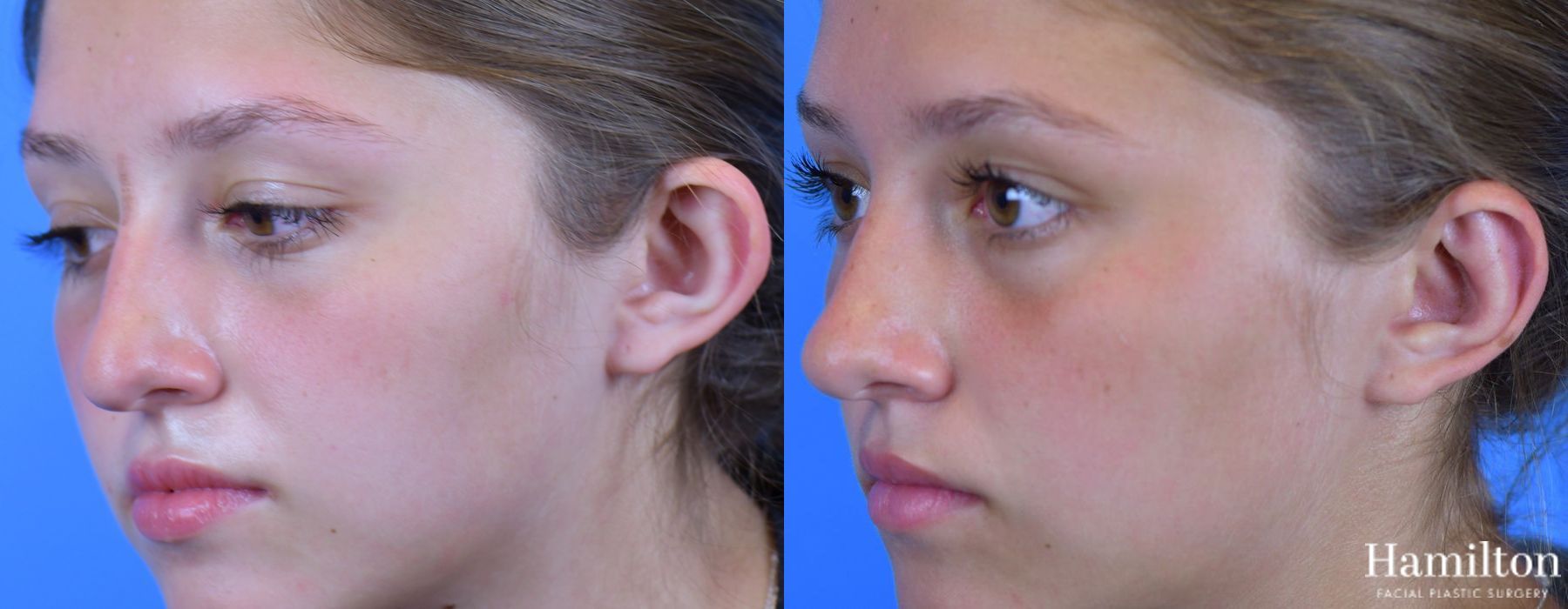 Before and after Otoplasty case 37093 - Angle 4
