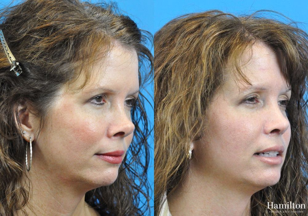 Before and after Rhinoplasty case 37292 - Angle 2