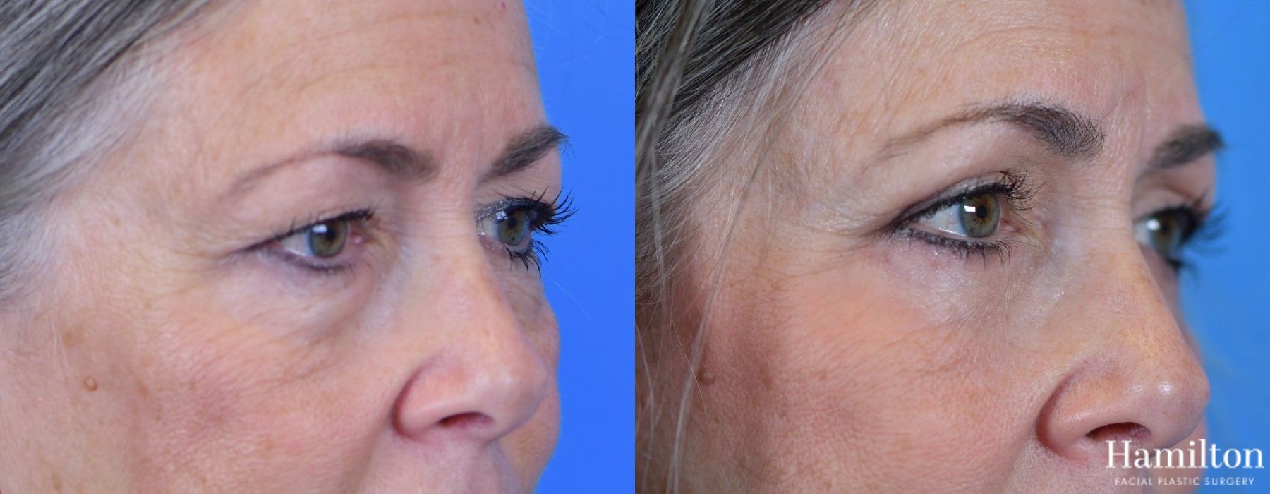 Before and after Blepharoplasty case 37267 - Angle 3