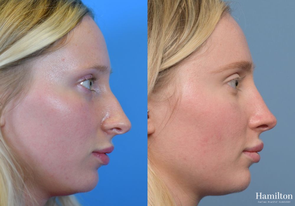 Before and after Rhinoplasty case 37157