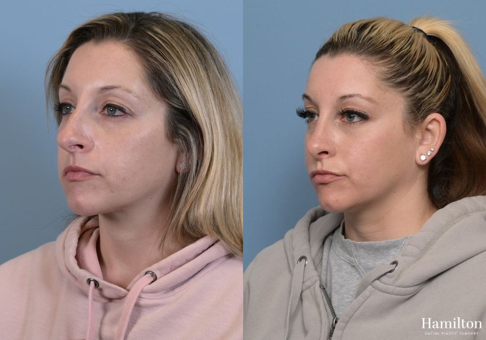 Before and after Rhinoplasty case 37239 - Angle 4