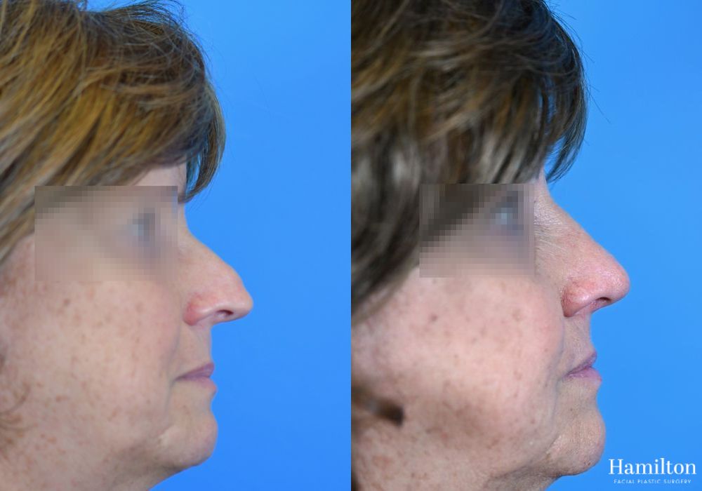 Before and after Rhinoplasty case 37337 - Angle 2