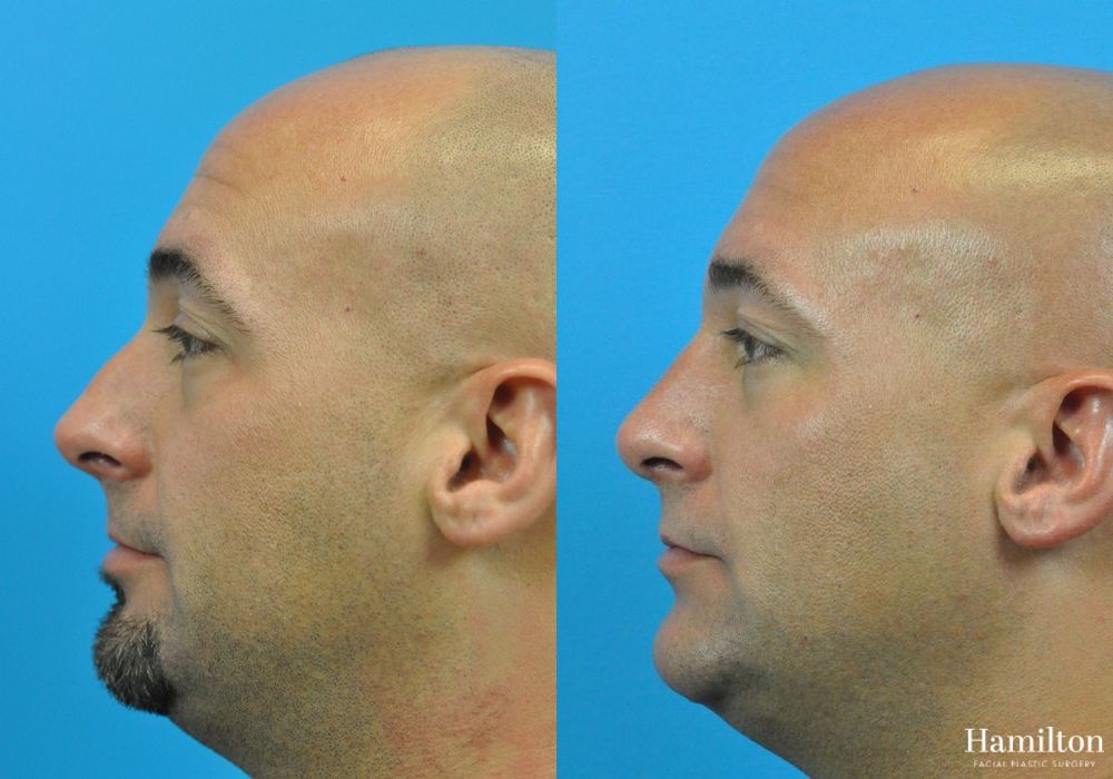 Before and after Rhinoplasty case 37255