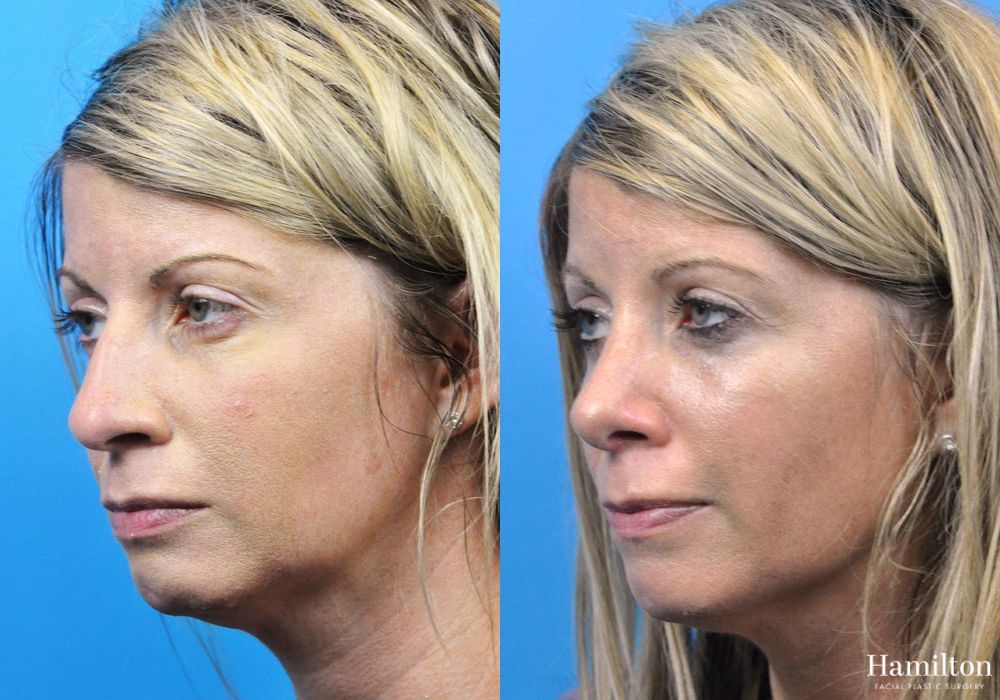 Before and after Rhinoplasty case 37334 - Angle 2