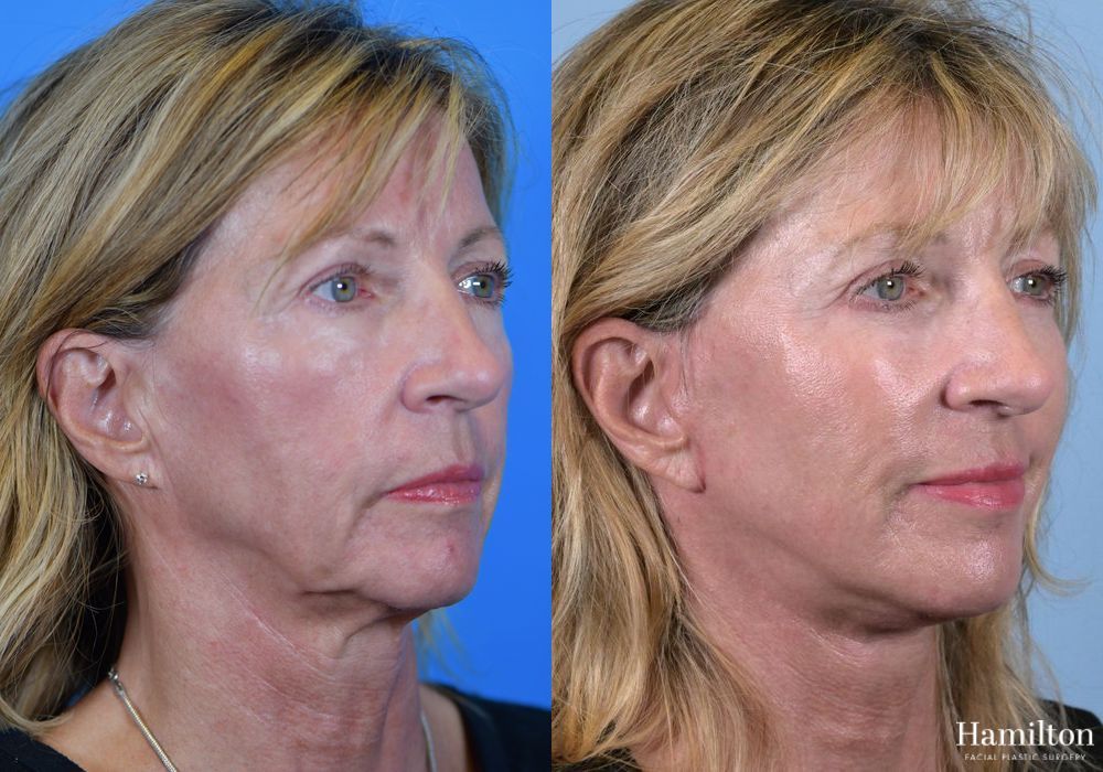 Before and after Facelift case 37279 - Angle 3