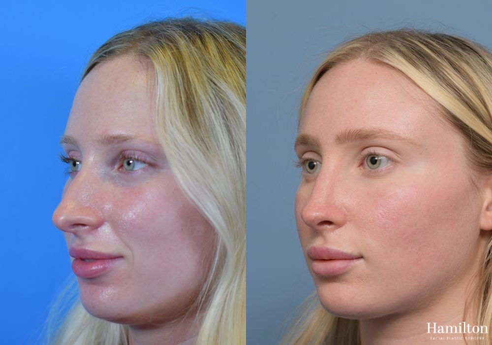 Before and after Rhinoplasty case 37157 - Angle 4