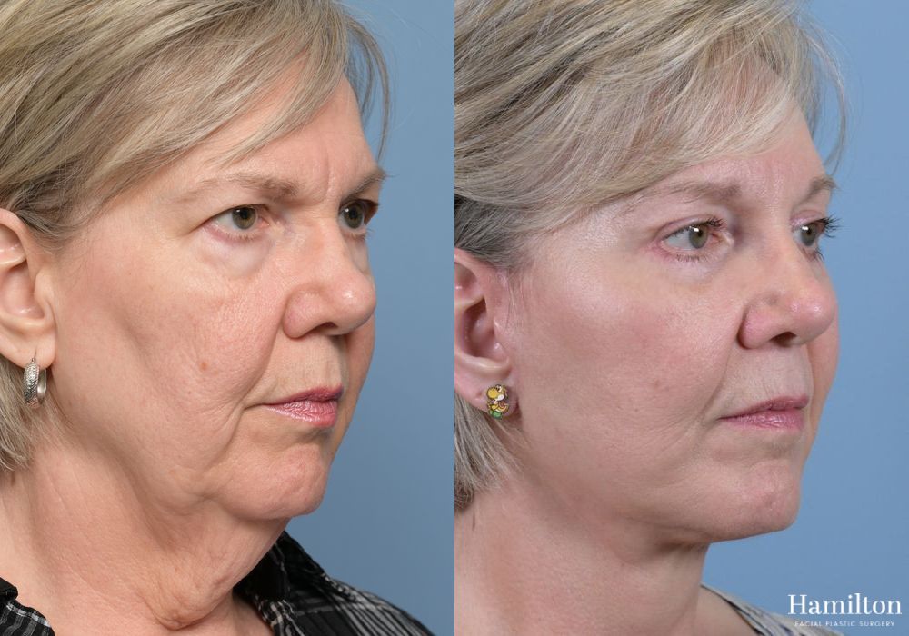 Before and after Brow Lift case 37139 - Angle 3