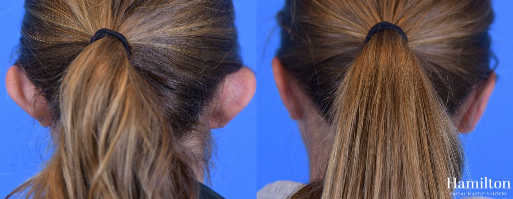 Before and after Otoplasty case 37093 - Angle 2