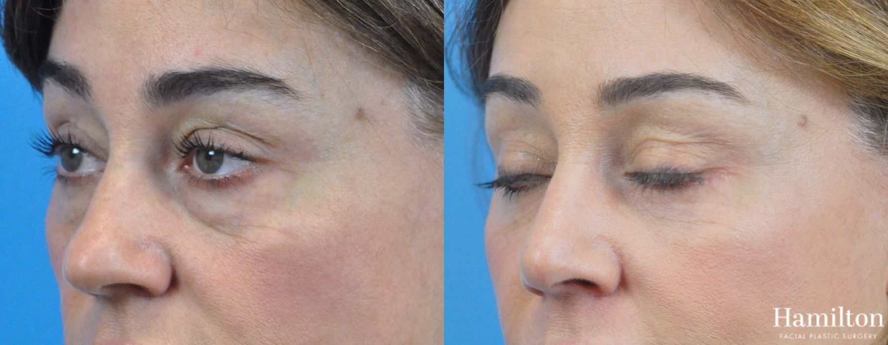 Before and after Rhinoplasty case 37329 - Angle 3