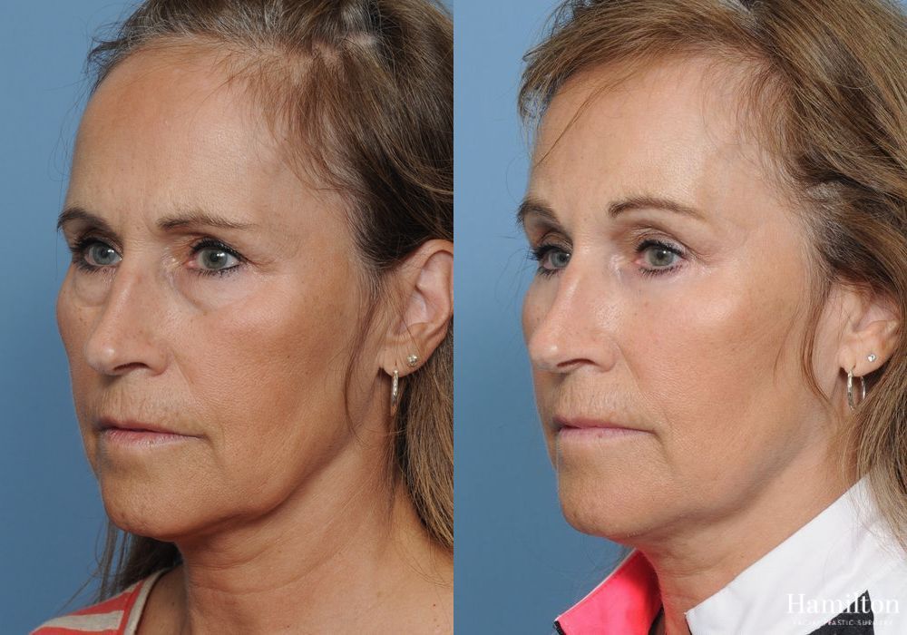 Before and after Brow Lift case 37225 - Angle 2