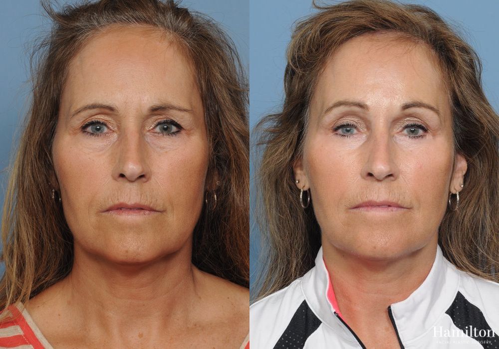 Before and after Brow Lift case 37225