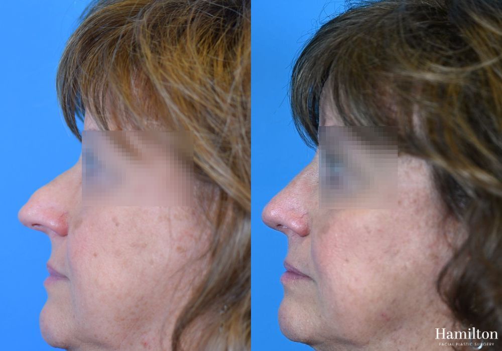 Before and after Rhinoplasty case 37337