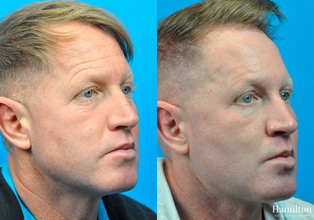 Before and after Laser - Fractional Resurfacing case 37344 - Angle 2