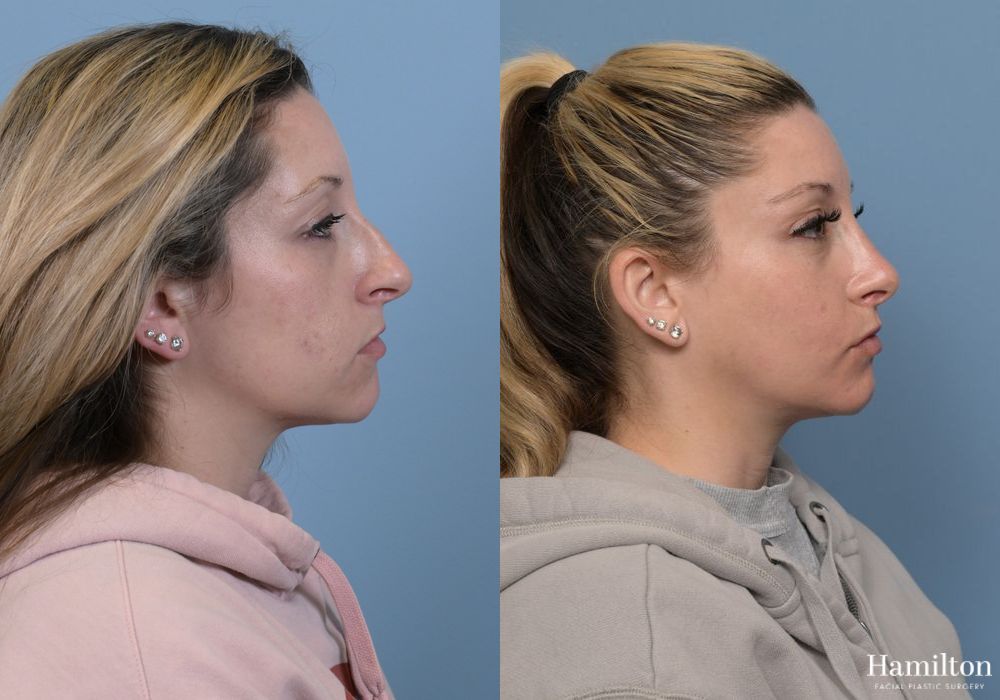 Before and after Rhinoplasty case 37239 - Angle 2