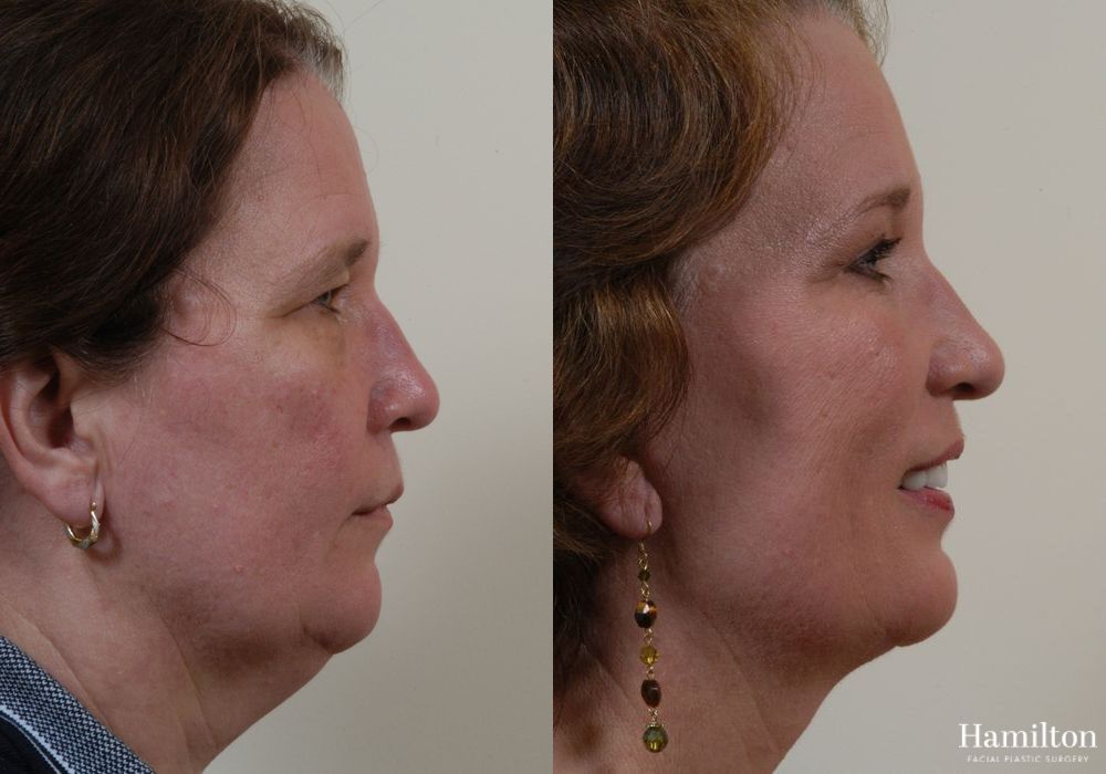 Before and after Facelift case 37265 - Angle 2
