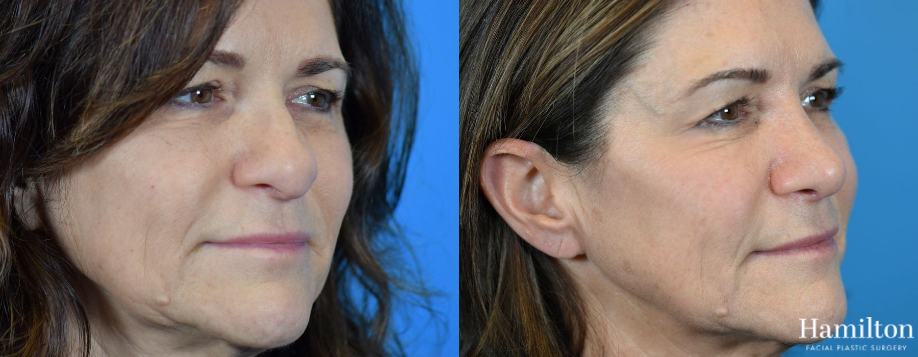 Before and after Rhinoplasty case 37299 - Angle 4