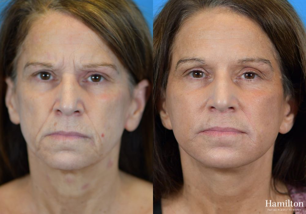 Before and after Facelift case 37273 - Angle 4