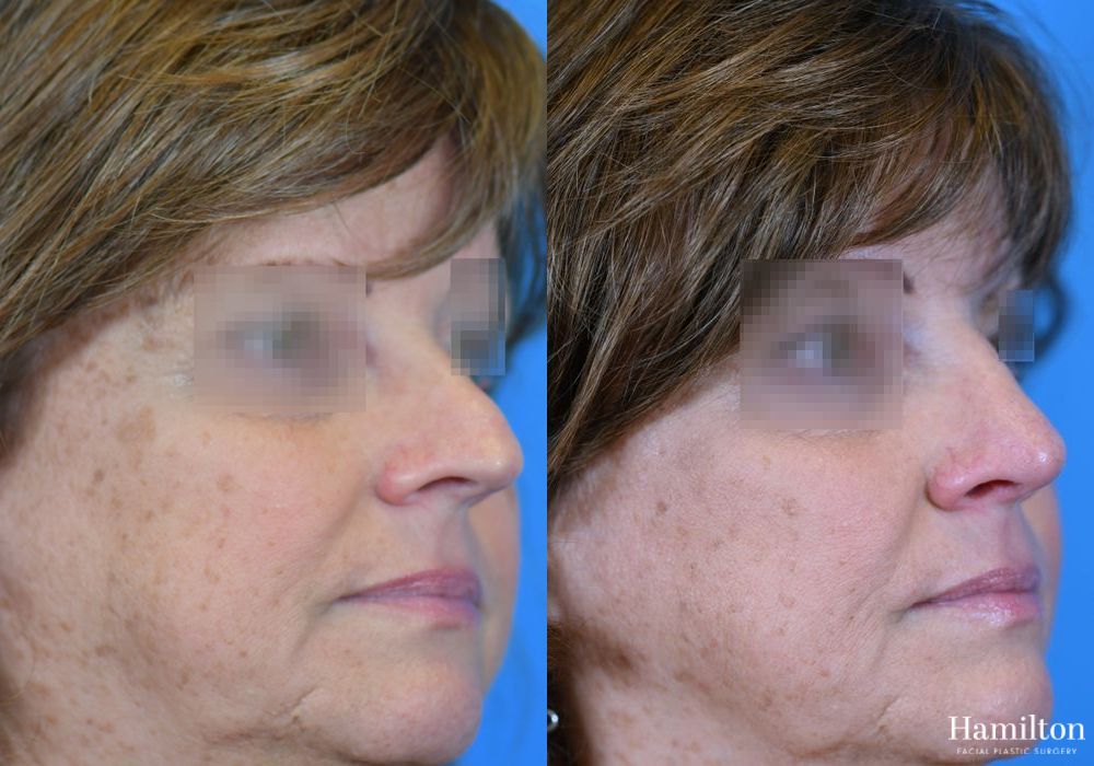 Before and after Rhinoplasty case 37337 - Angle 3