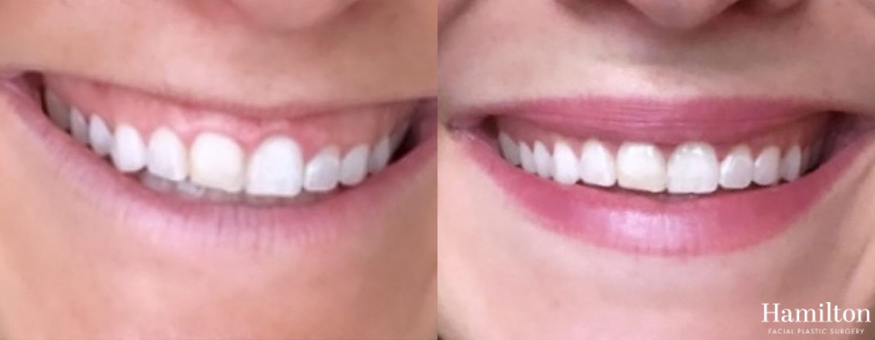 Before and after Neurotoxins/BOTOX case 37102