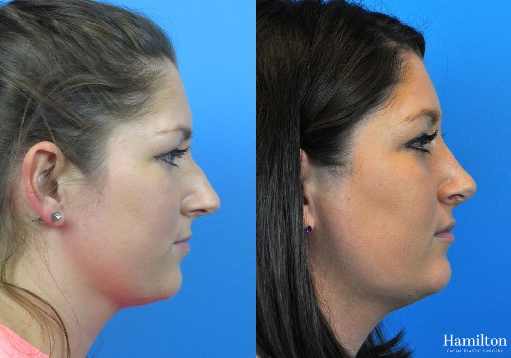 Before and after Rhinoplasty case 37356