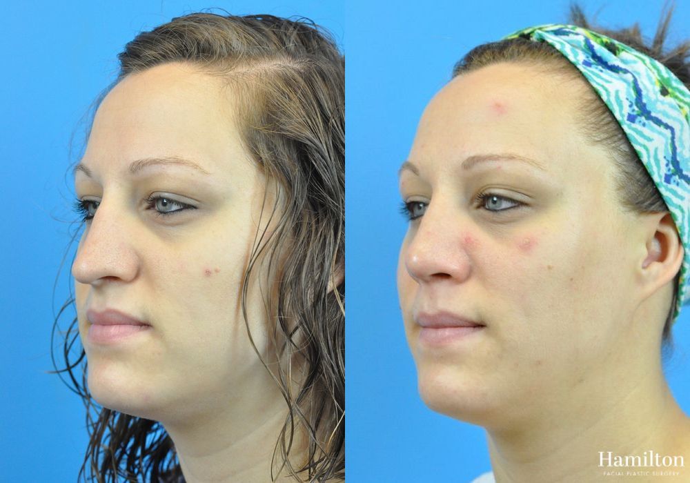 Before and after Rhinoplasty case 37357 - Angle 3