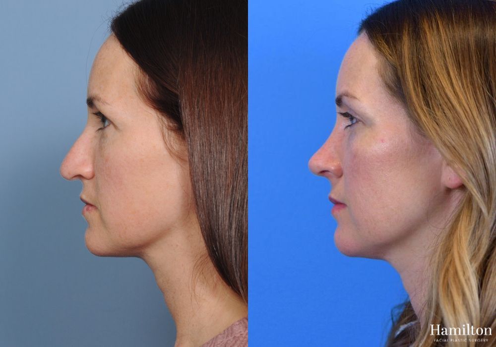 Before and after Rhinoplasty case 37199