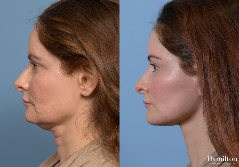 Before and after Neck Rejuvenation case 37096 - Angle 3