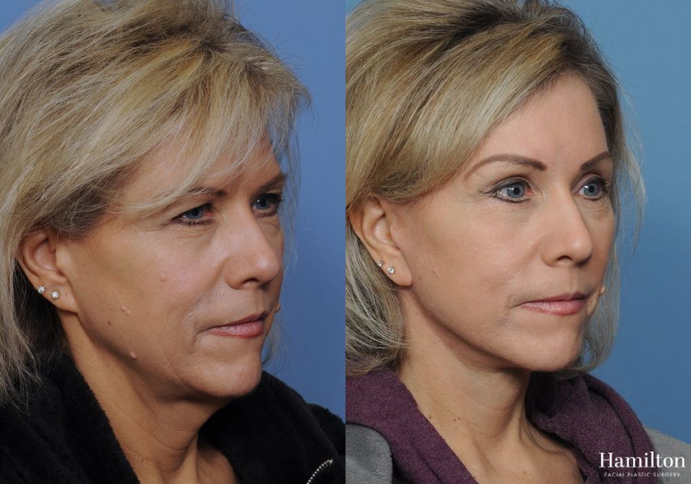 Before and after Brow Lift case 37151 - Angle 2