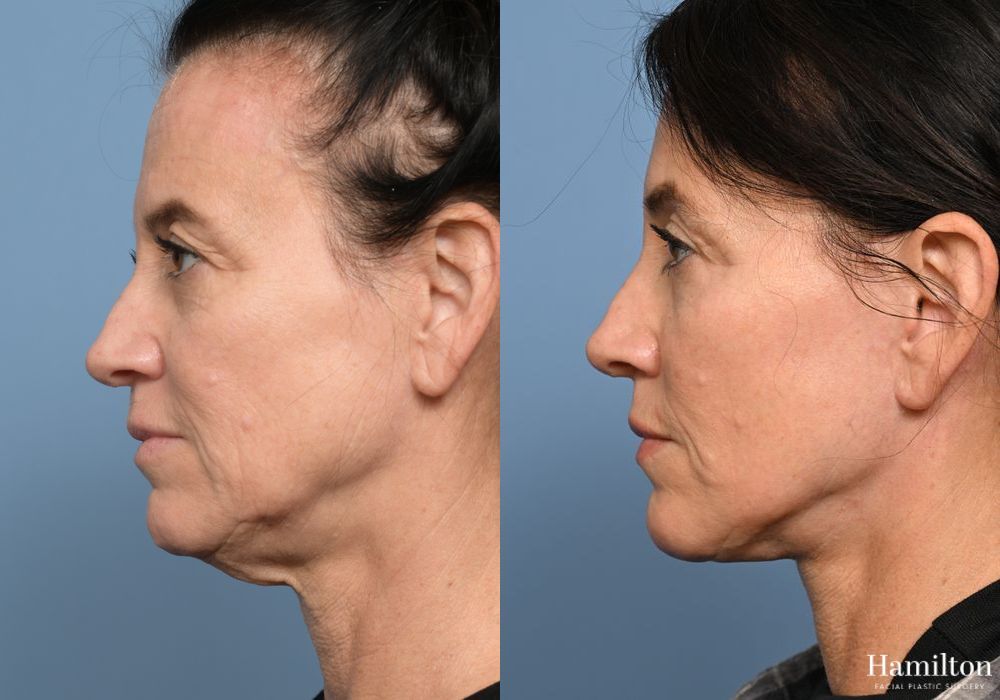 Before and after Facelift case 37315 - Angle 5