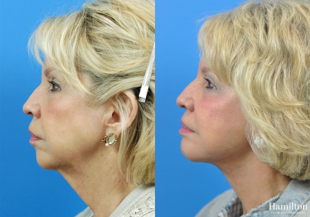 Before and after Facelift case 37314 - Angle 3