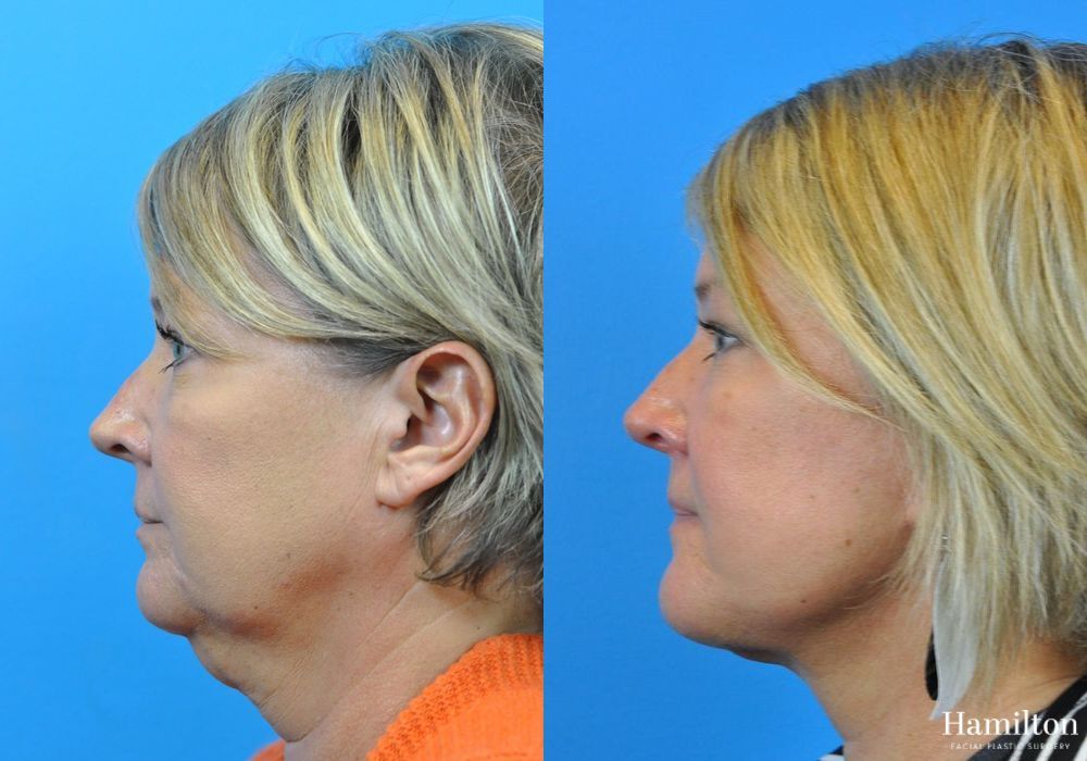 Before and after Neck Rejuvenation case 37172