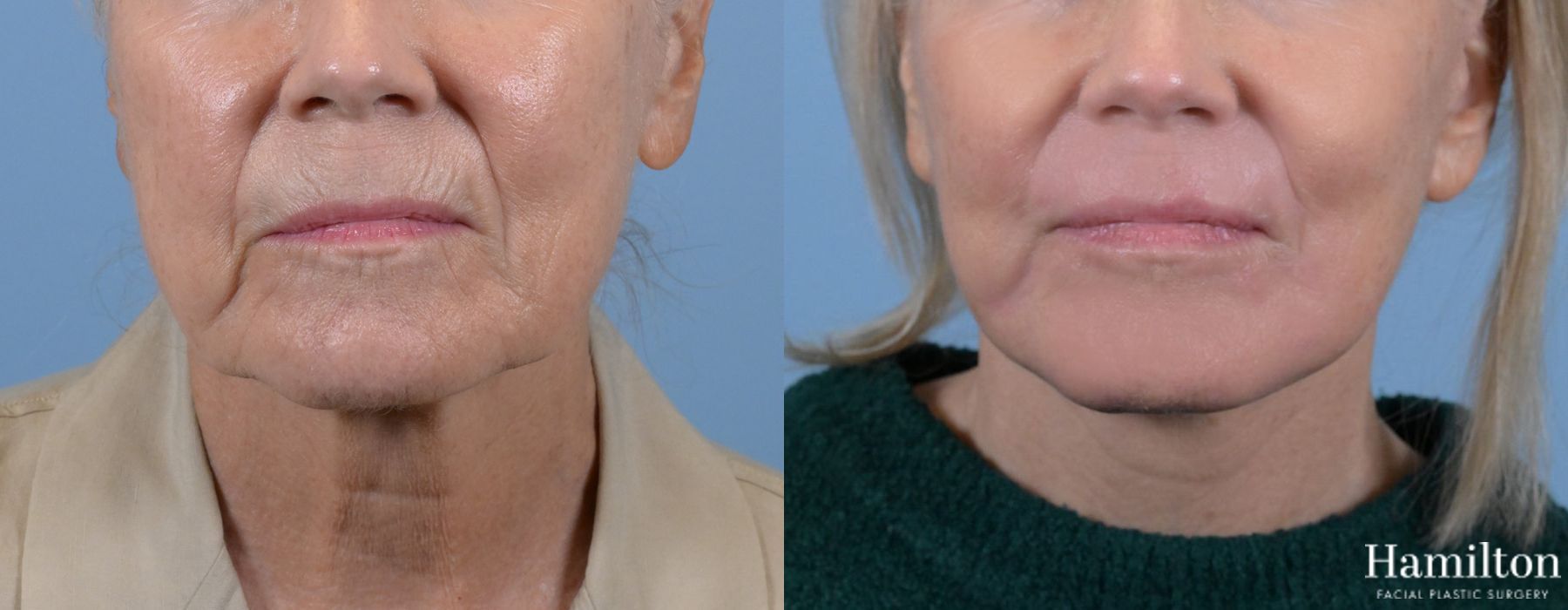 Before and after Laser - Sciton case 37089