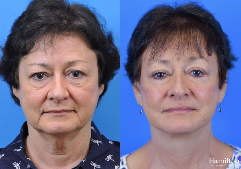 Before and after Facelift case 37296 - Angle 2