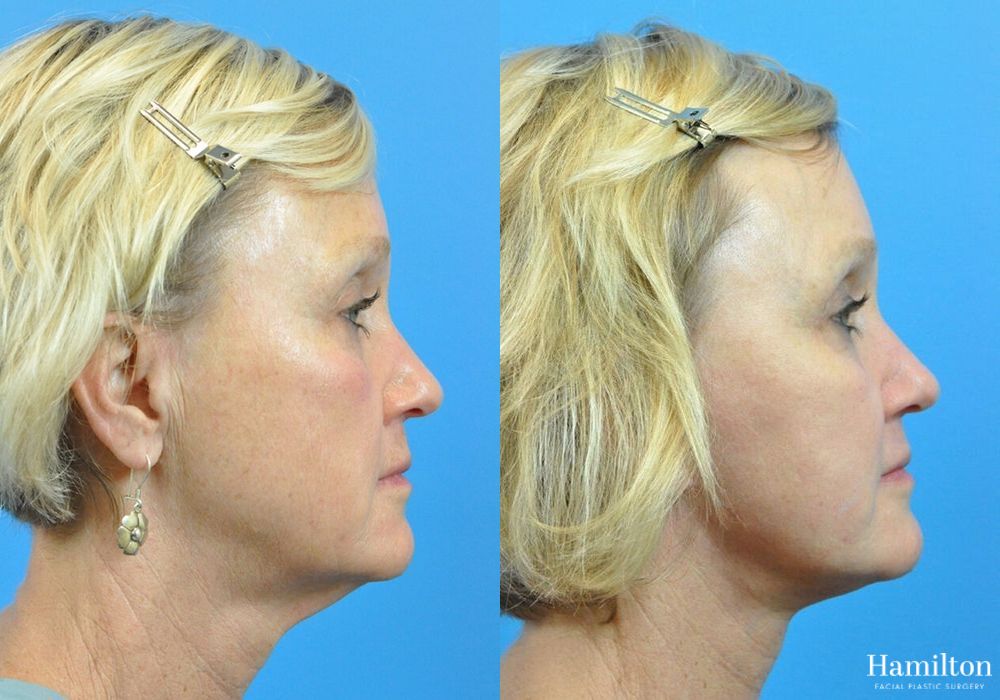 Before and after Facelift case 37322 - Angle 3